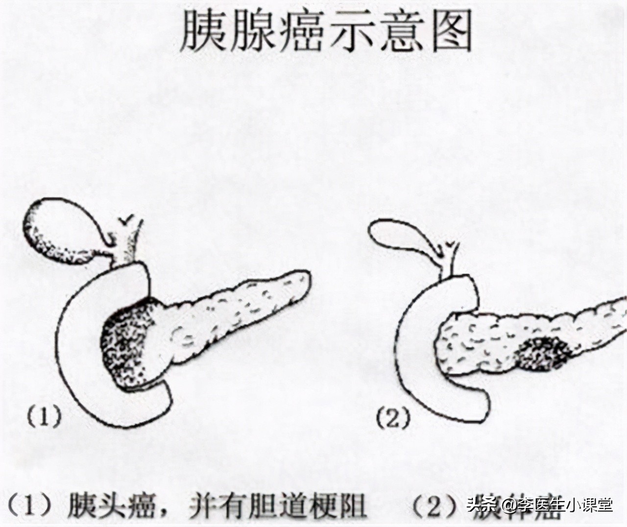 做彩超和增强CT都怀疑胰腺癌，做核磁没发现病灶，听医生怎么说