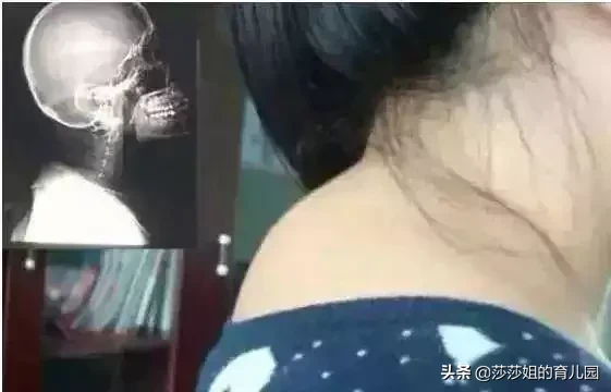 脖子后有一个治颈椎病的重要穴位,你知道吗?