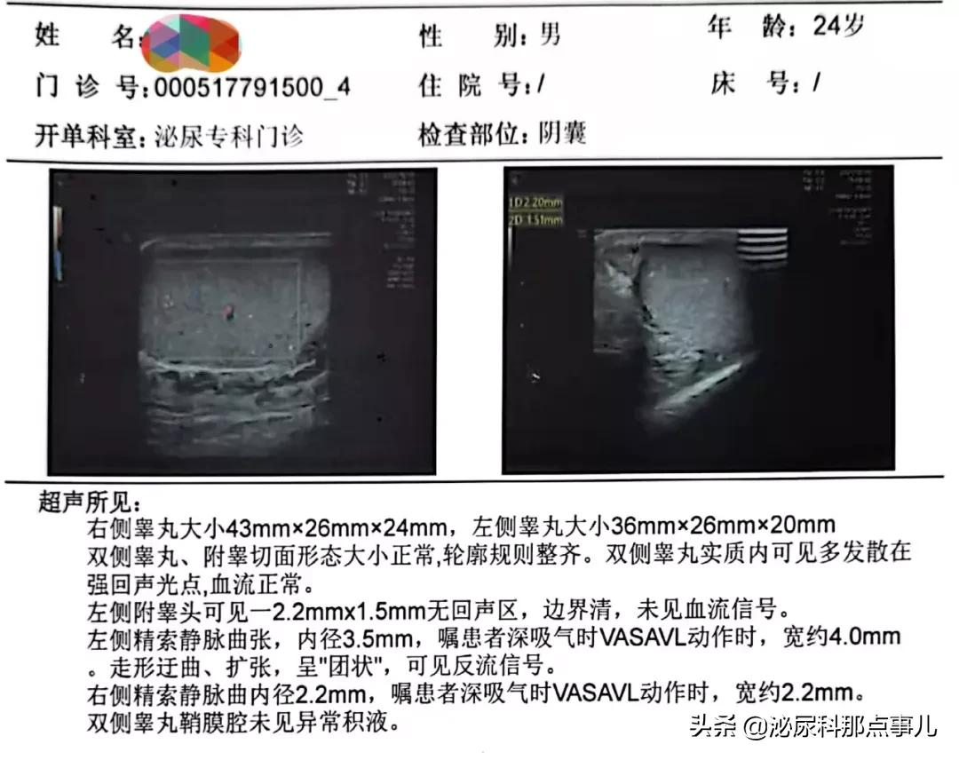 精索静脉曲张何去何从——显微镜下精索静脉结扎术