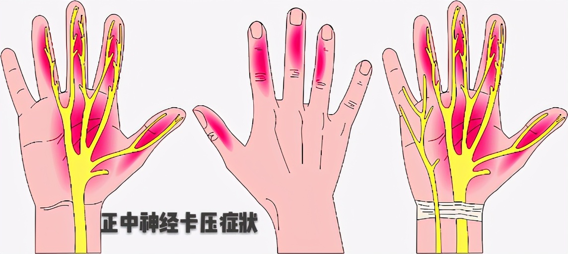 导致手指麻木的疾病，不仅是颈椎病！医生教您几招，判断手麻病因