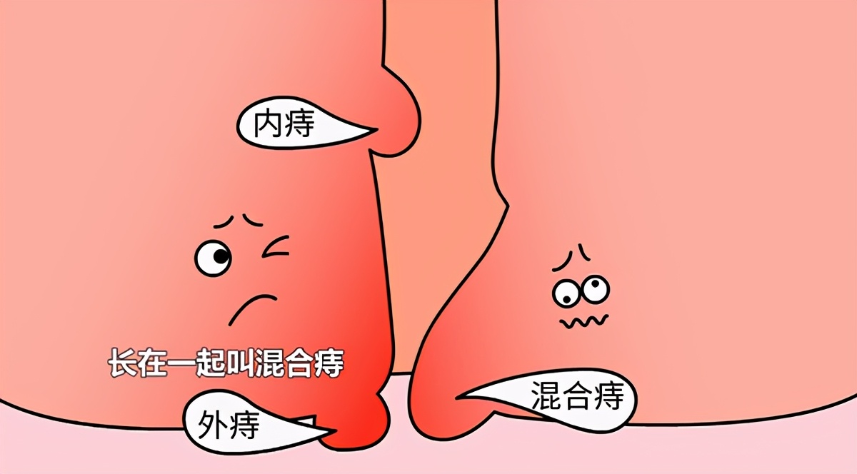 痔疮反复发作，应该用痔疮膏还是痔疮栓？哪种效果更好？