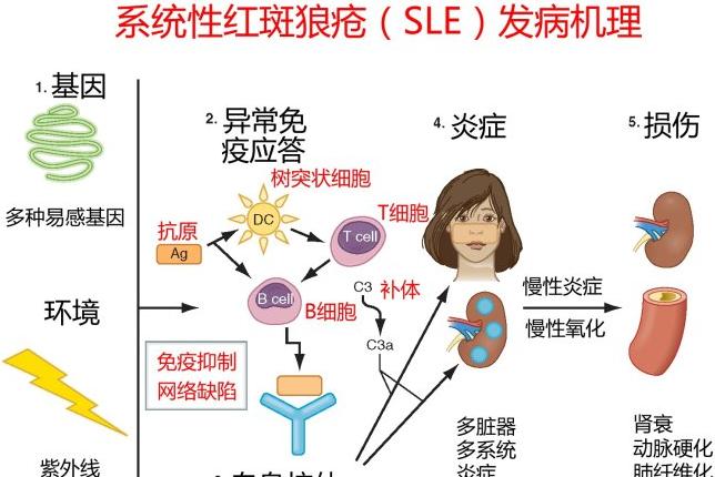 红斑狼疮早期四大症状要记牢，越早治疗越好