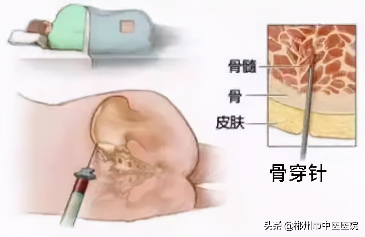 骨髓穿刺是怎么回事？对身体伤害大吗？