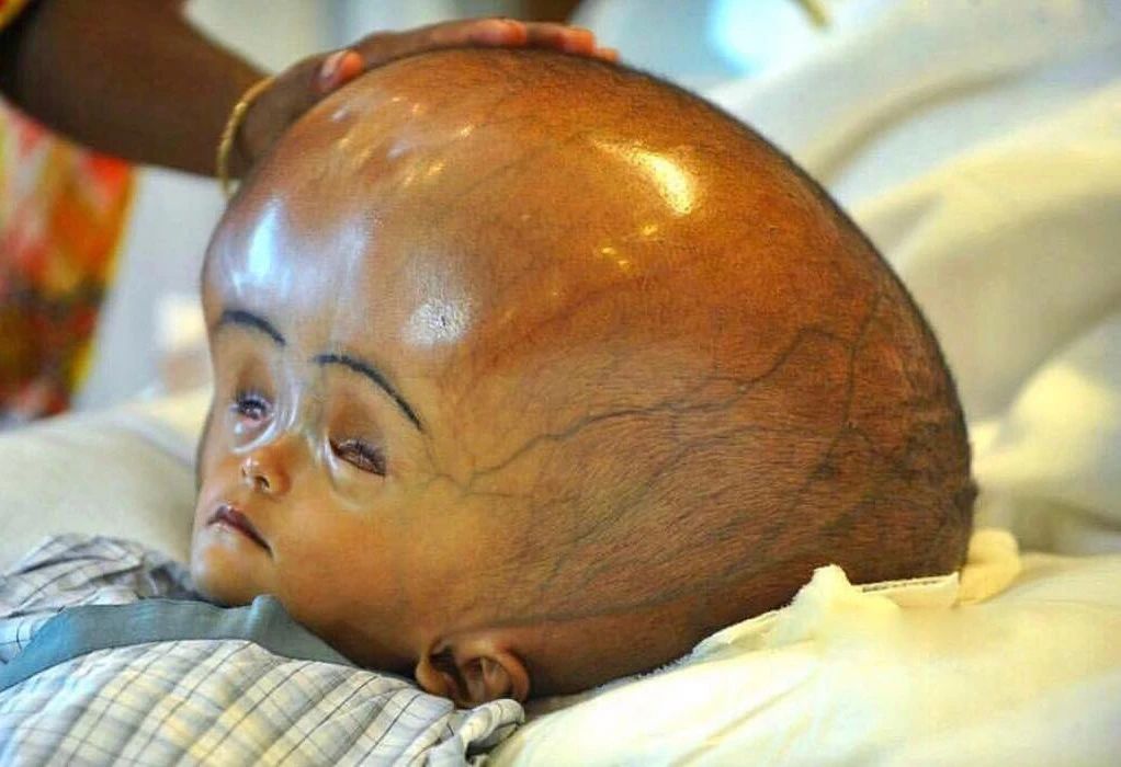 孩子的头大、头小、偏头，方颅，是什么原因？一次性弄清楚