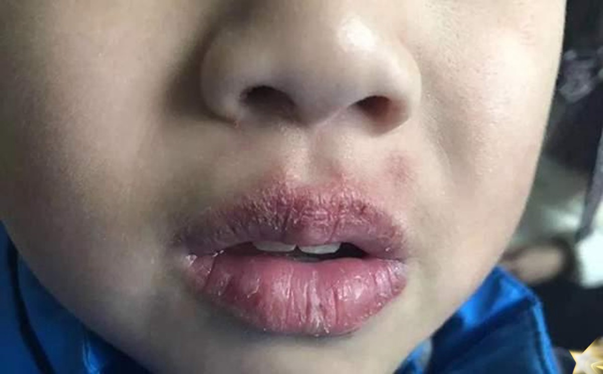 孩子嘴唇干裂、起皮还出血怎么办？医生教你正确护理，比喝水管用