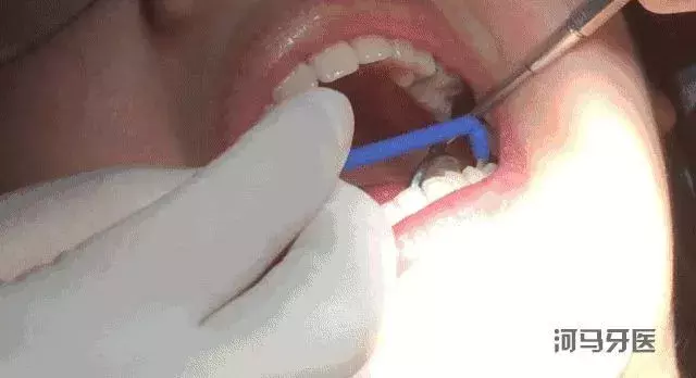 涂氟能预防蛀牙!孩子多大能涂?多长时间涂一次?需要注意啥?
