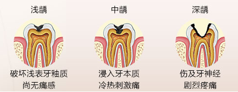 我只是掉了一颗牙而已，不影响吃饭，可以不做种植牙吗？