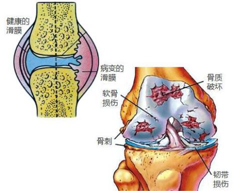 关节炎只能注射这4种保养剂，2018年12月最新指南推荐！