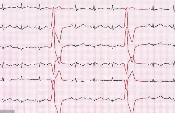 辟谣|什么是“心脏早搏”？严重吗？怎么治？