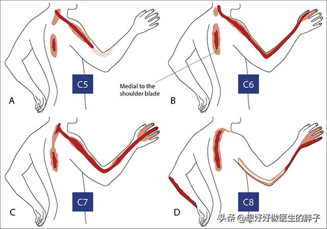 颈椎间盘突出或骨刺压迫神经会引起什么症状？如何治疗？如何康复
