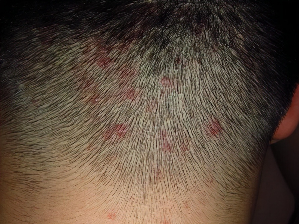 头上摸到的小疙瘩到底是什么？影响健康吗？医生一文解释清楚