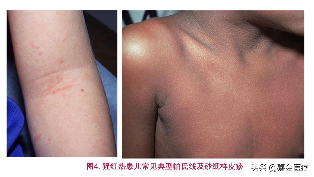 黏膜充血舌上有4种舌乳头,包括丝状乳头,菌状乳头,叶状乳头和轮廓乳头