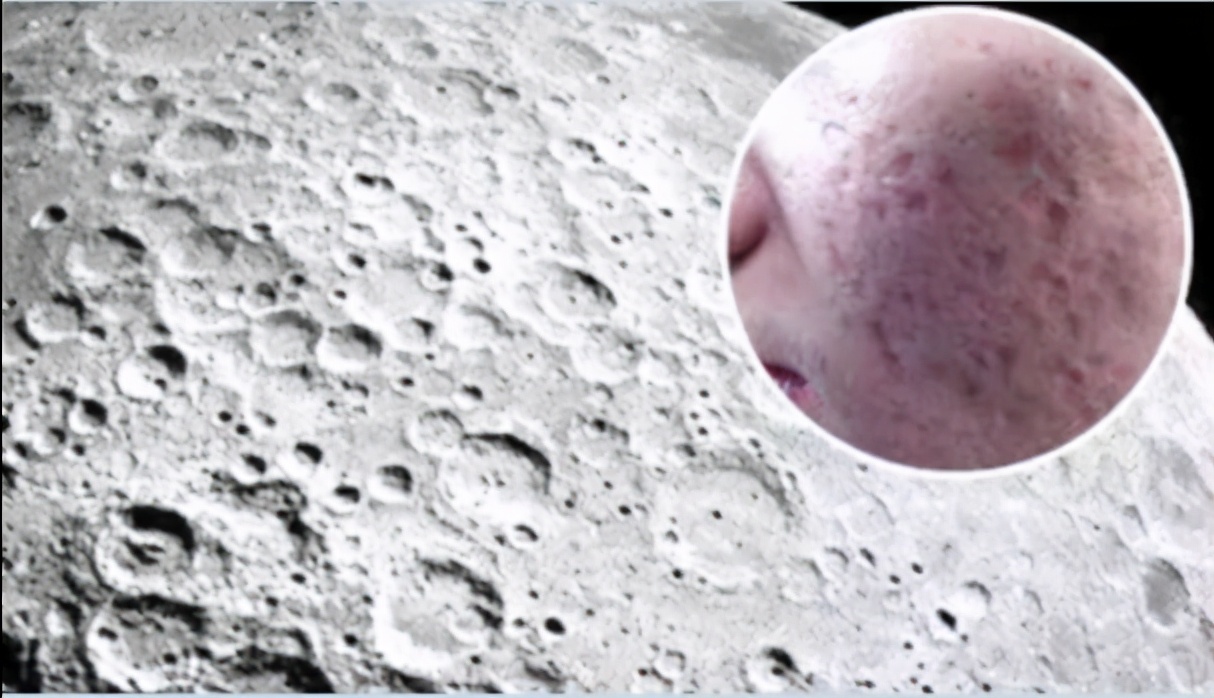 应该没有人会喜欢一张凹凸不平的月球脸吧?平时都不敢素颜出门?