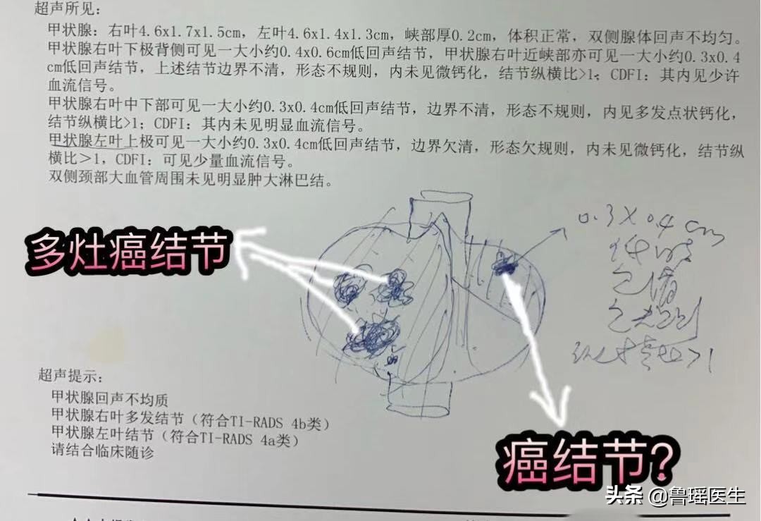 不同医院做的甲状腺B超结果会有差异吗？