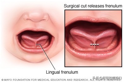 全球4-11%新生儿舌系带都过短。宝宝到底有没有必要挨一刀？