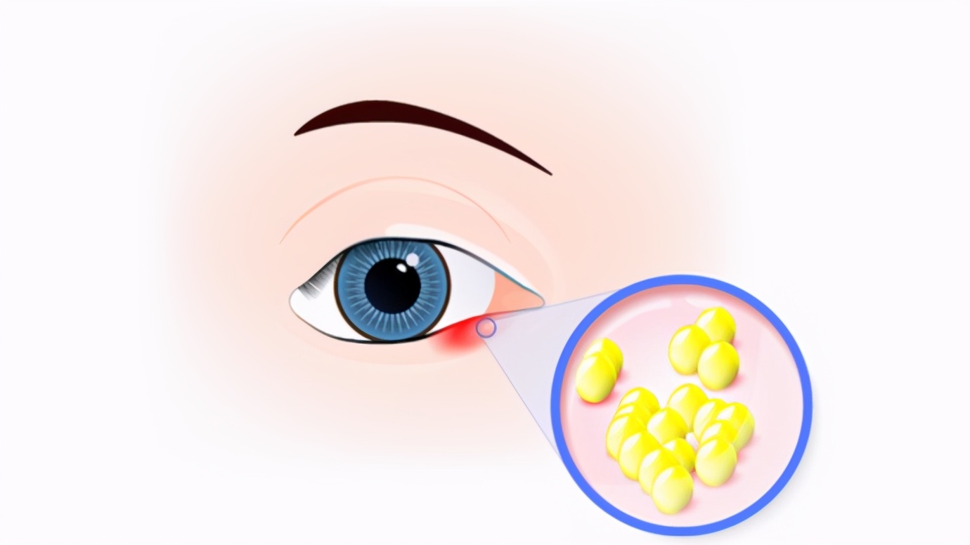 长针眼是什么原因引起的可以通过哪些食物进行食疗