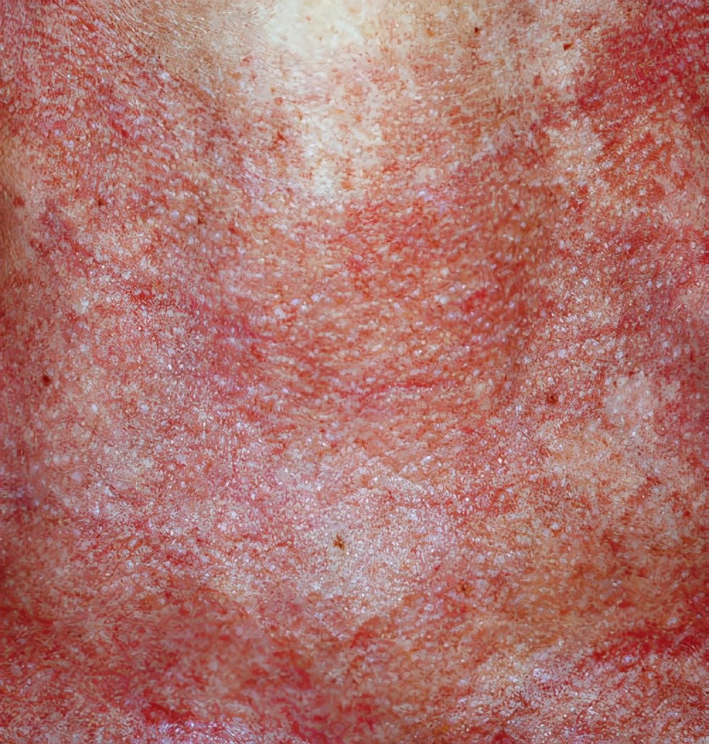 皮肌炎有什么样的皮肤改变?(1)