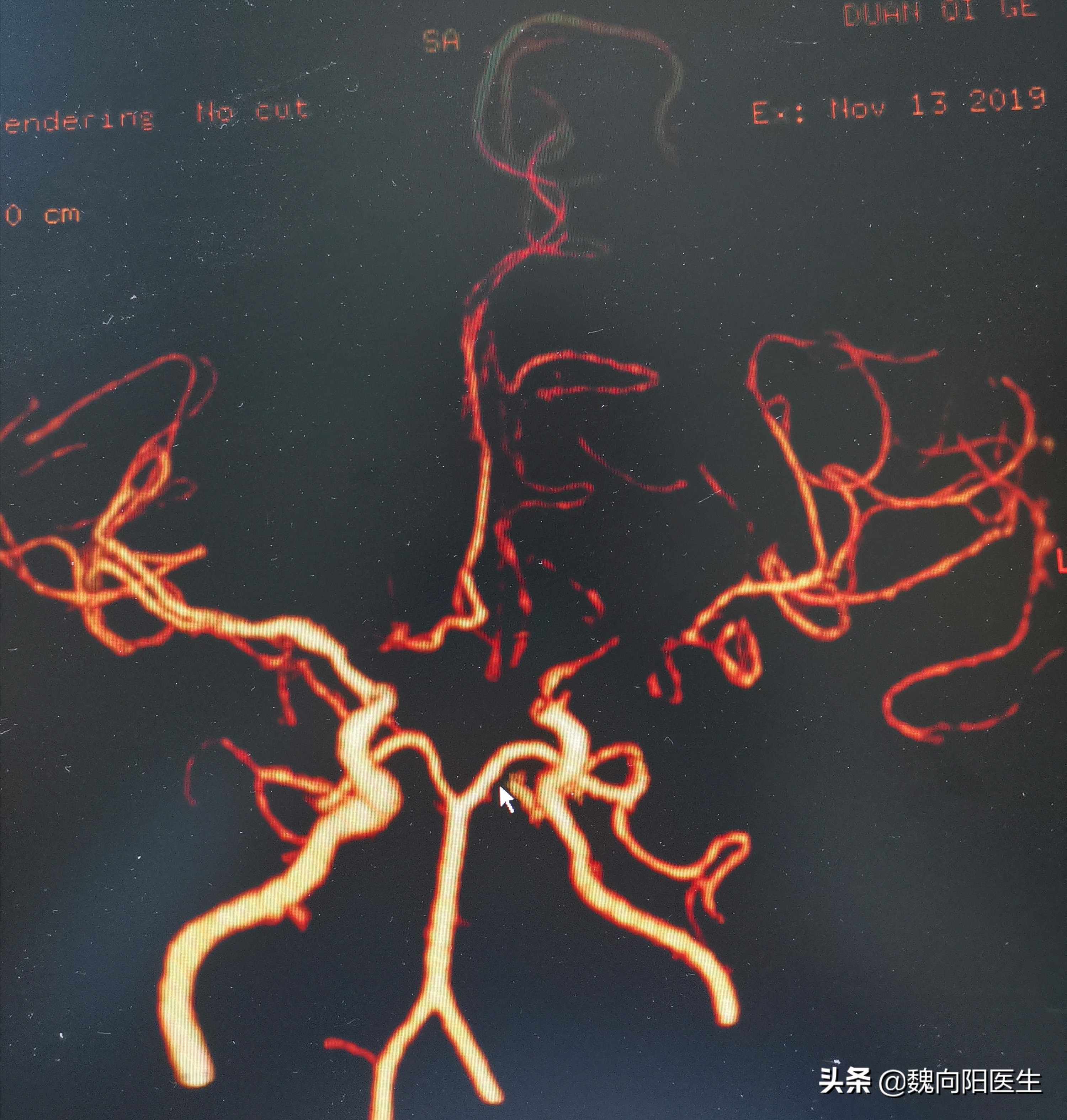 医生说的血管造影与患者认为的“血管造影”是一个检查吗？