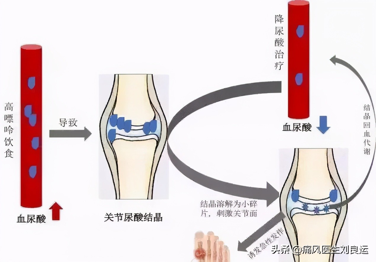 印度的非布司他比国产药降尿酸效果更好？治疗痛风请先对症再用药