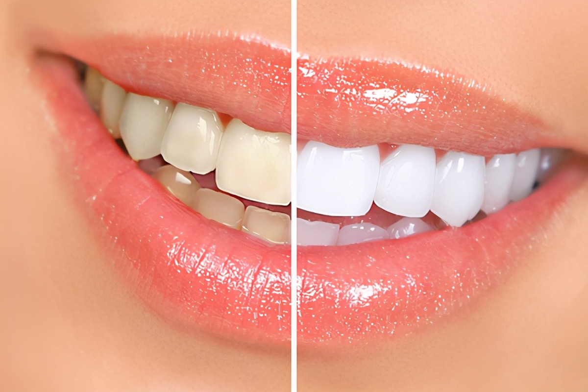 面对琳琅满目的牙齿美白产品，你挑花眼了吗？