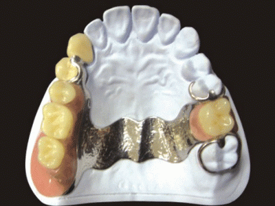 各类假牙汇总，最贵的假牙价值近百万