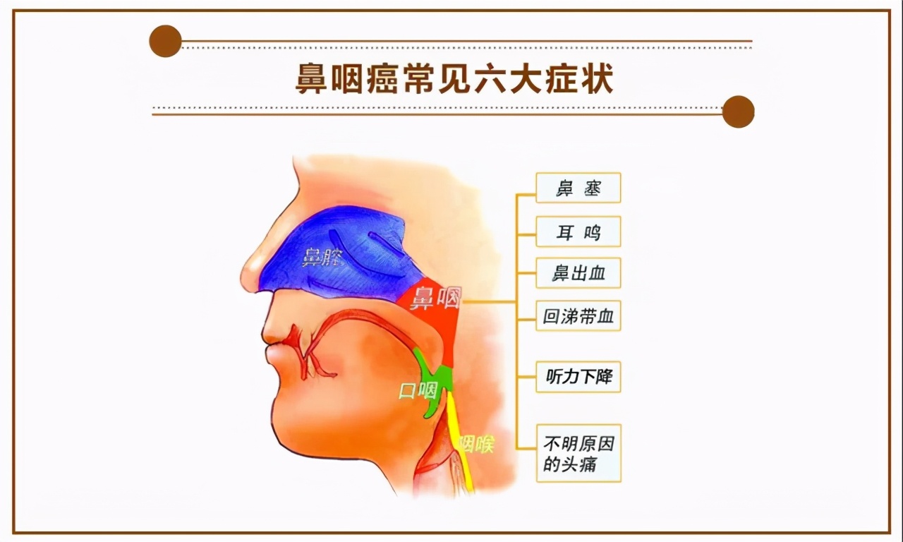 鼻咽癌得病率高？医生提醒：有5个征兆，真希望你能避开