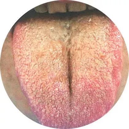 燥苔主要是体内津液已伤.