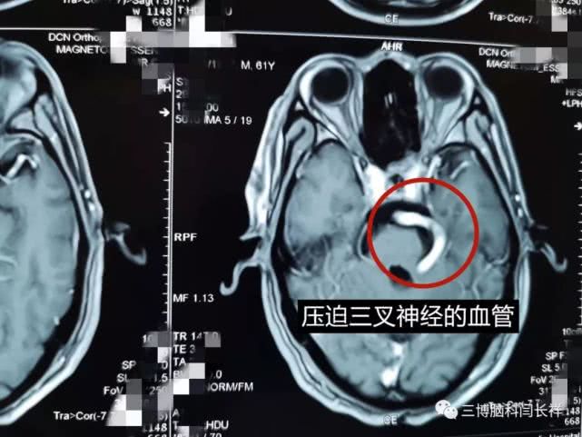 厦门一男子拔牙6颗，牙痛依旧，一查竟是“天下第一痛”惹的祸
