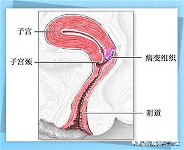 没遇上卵子的精子，最终会去哪里？