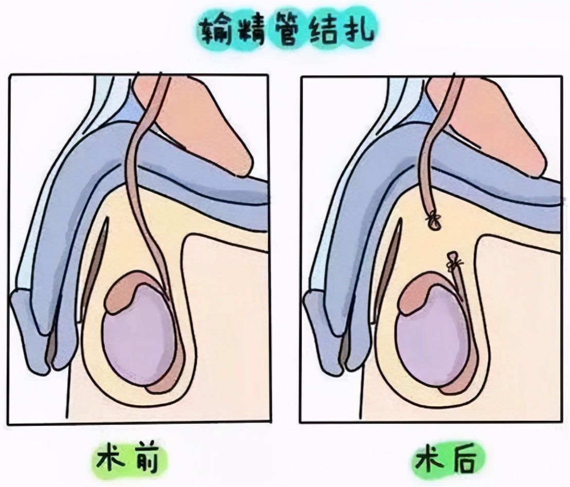 输精管结扎,简单来说就是将运送精子的管道(输精管,用手术的手段进行