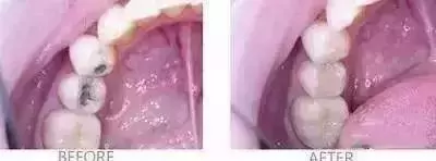 你补过牙吗?知道价格为什么差那么多吗?