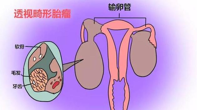 畸胎瘤该怎么办？