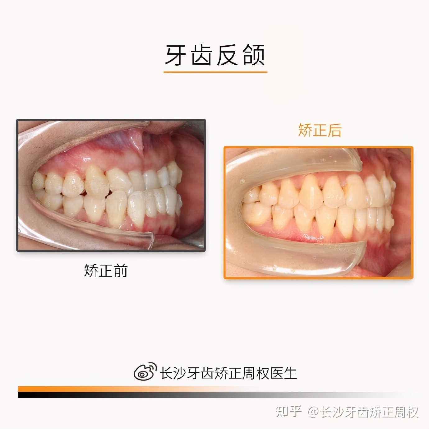 长沙牙齿矫正｜正畸合集：牙齿拥挤、龅牙、地包天、深覆合