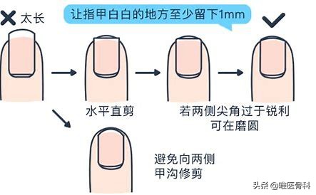 这样治「甲沟炎」，只要 3 块钱，简单管用少花钱