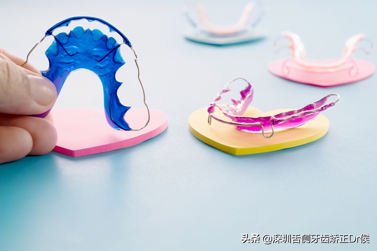 舌侧保持器价格别说我没告诉你