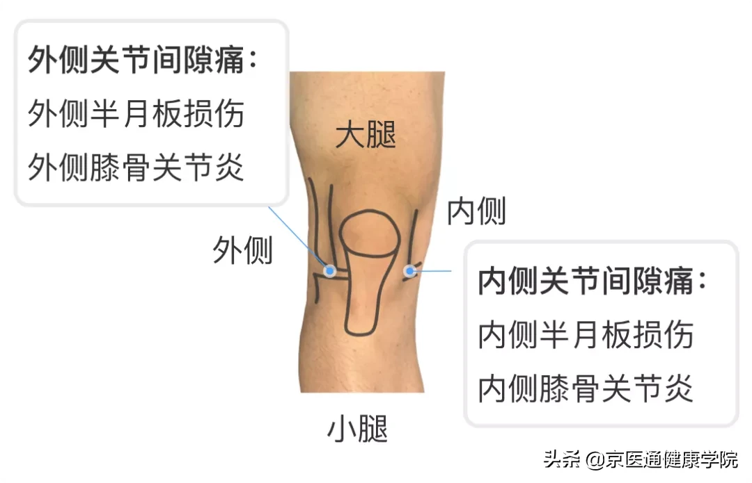 膝盖疼是什么病？积水潭专家教你1个动作判断