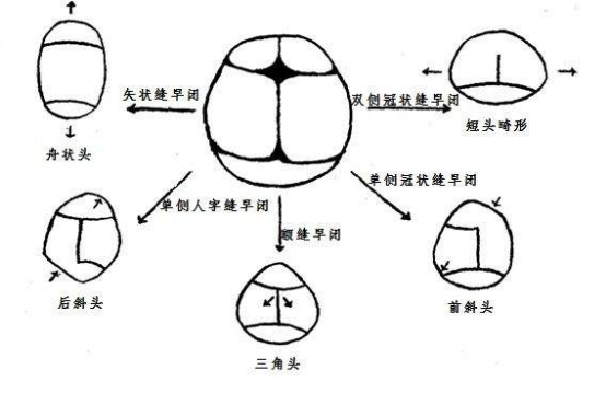 孩子的头大、头小、偏头，方颅，是什么原因？一次性弄清楚