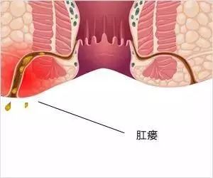 婴儿屁股小肉芽图片（屁股上长了一个小洞）