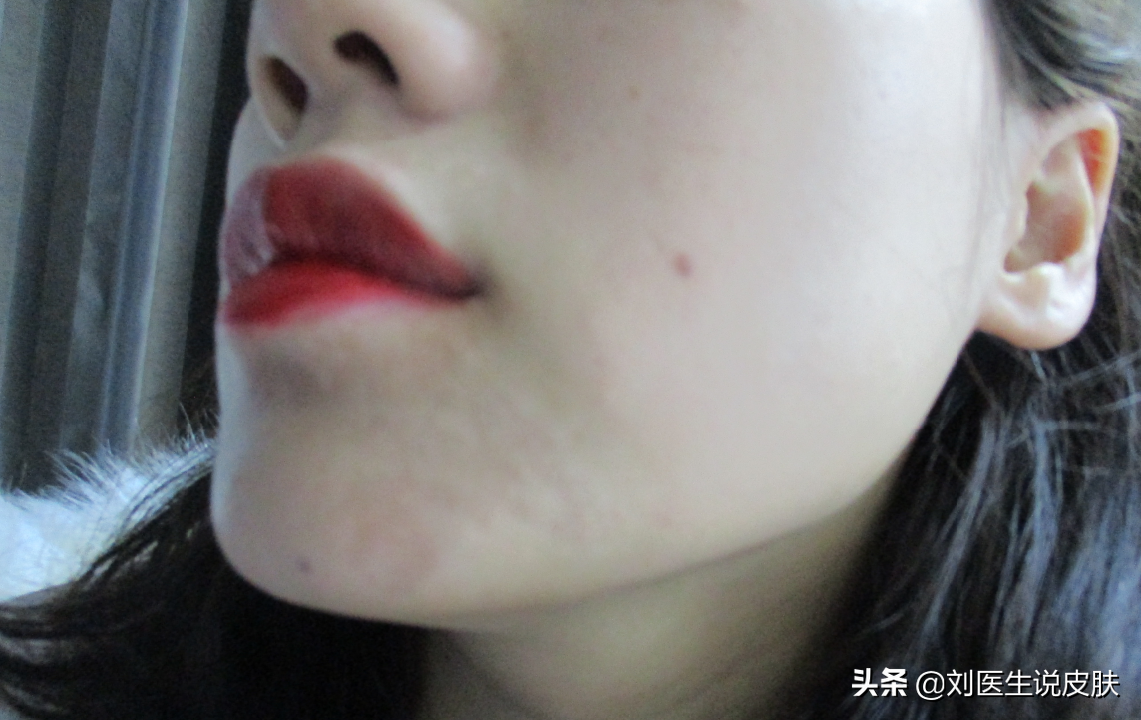 20岁女子患白癜风后，牢记医生说的这3个原则，然后白斑就没了