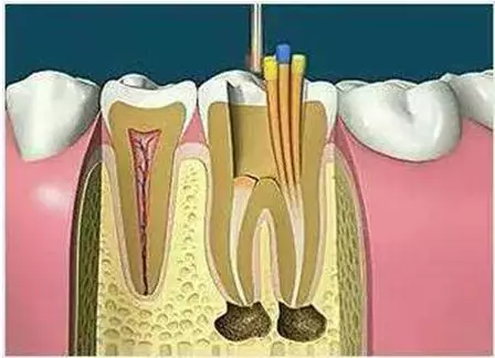 什么是牙齿打桩？什么是根管治疗？这篇建议收藏 #雅悦齿科#