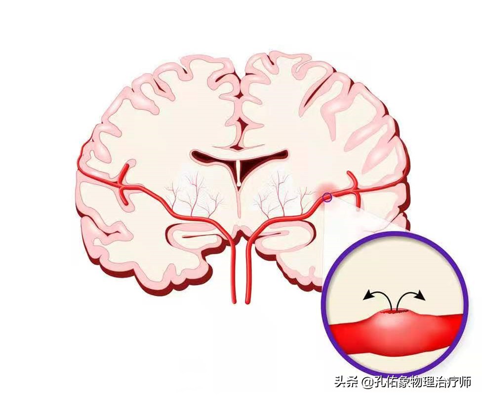 为何如此多的人发生脑出血？要如何正确应对？一文详细告知您