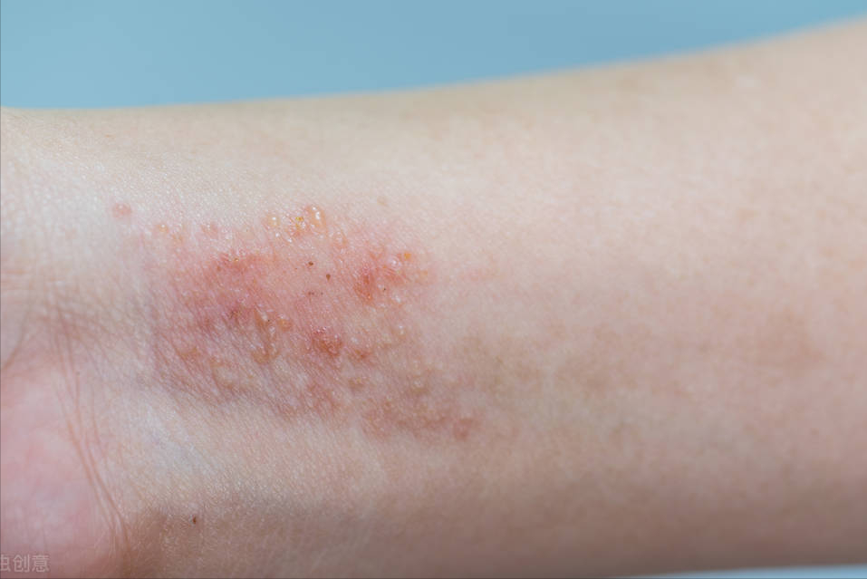 对称性湿疹图片(为什么湿疹反反复复) - 赤虎壹号