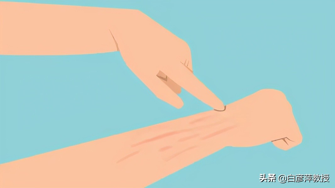 轻轻一划，皮肤上就凸起一道红痕？要警惕皮肤划痕症“作怪”