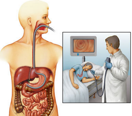 无痛胃镜和普通胃镜，哪一个更好？看胃肠医生的选择就知道了