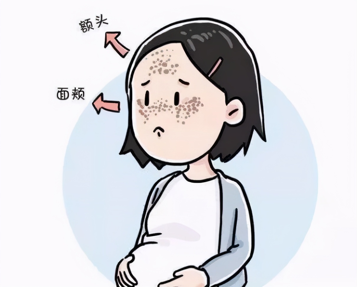 黄褐斑,长在脸的两侧皮肤,主要是黄褐色的,甚至带有一点粉红色,散在在