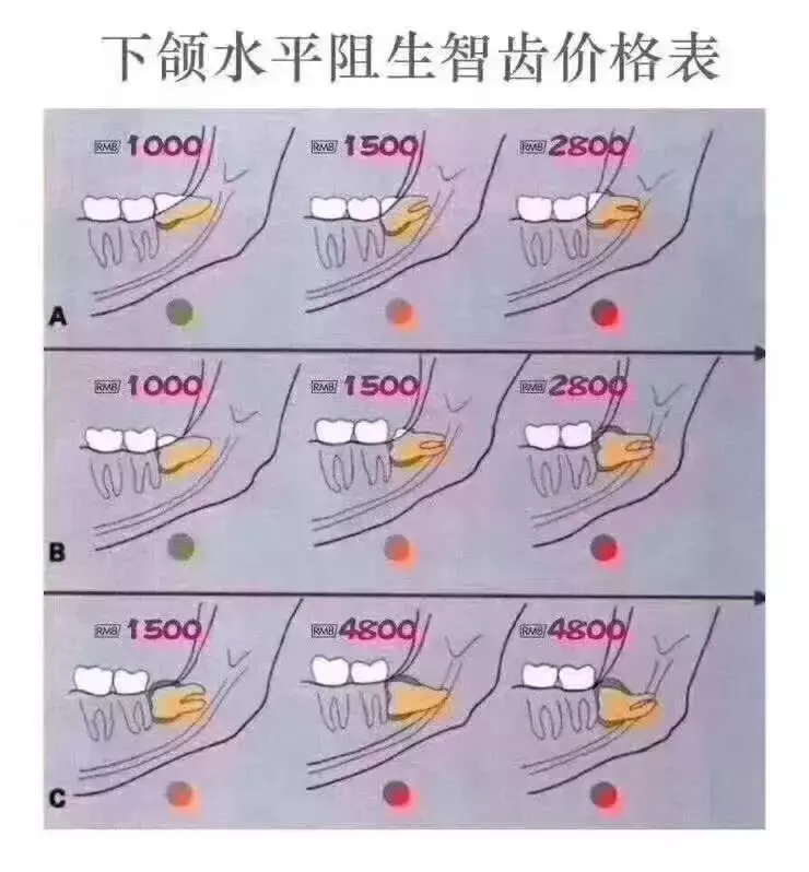 一起去拔智齿,为啥收费差别这么大?拔智齿按什么标准收费的?