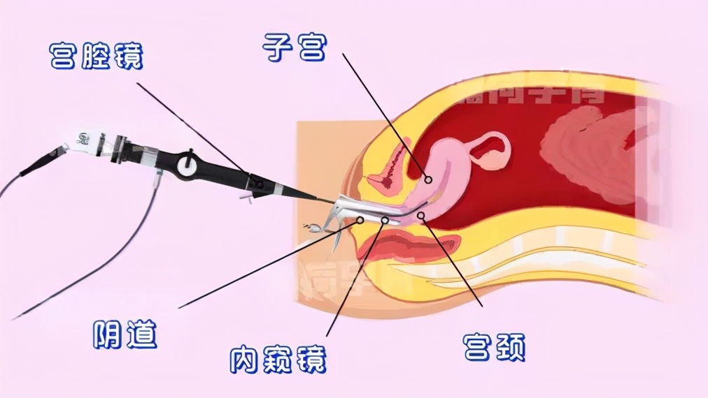 试管必备的检查之一：宫腔镜详解