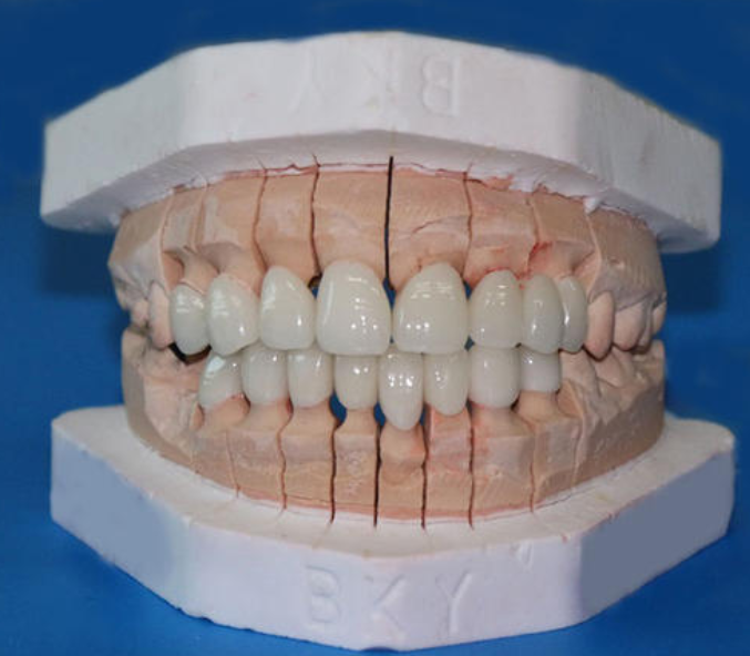 一个与原来的真牙完全相同的瓷牙,然后通过手术,安装在牙齿缺损的位置