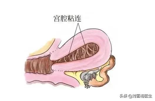 输卵管造影疼吗？做完多久可以要孩子？你想问的这里都有答案