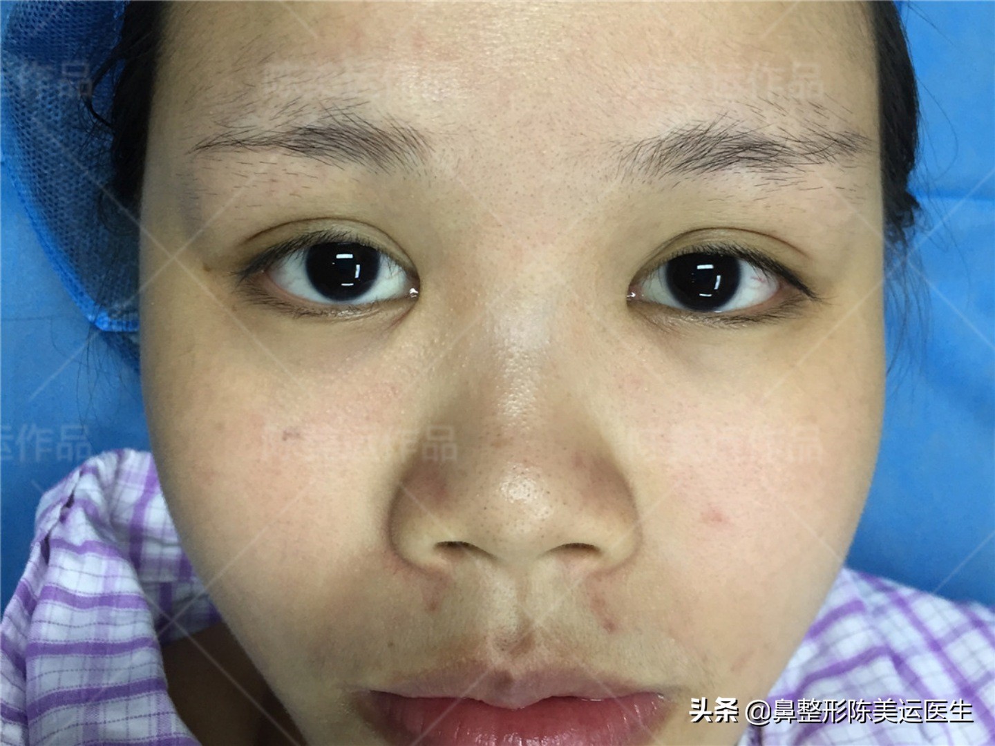 朝天鼻矫正难度大？难度有多大，效果就有多惊艳